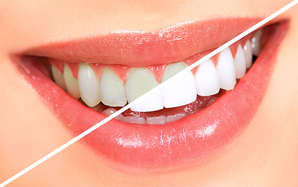 Cách Làm trắng Răng